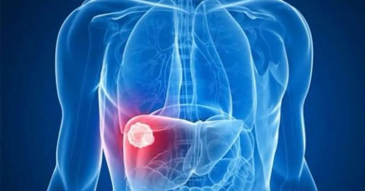 Shoulder Pain Could Be More Than a Muscle Problem: What You Should Know About Liver Cancer Warning Signs