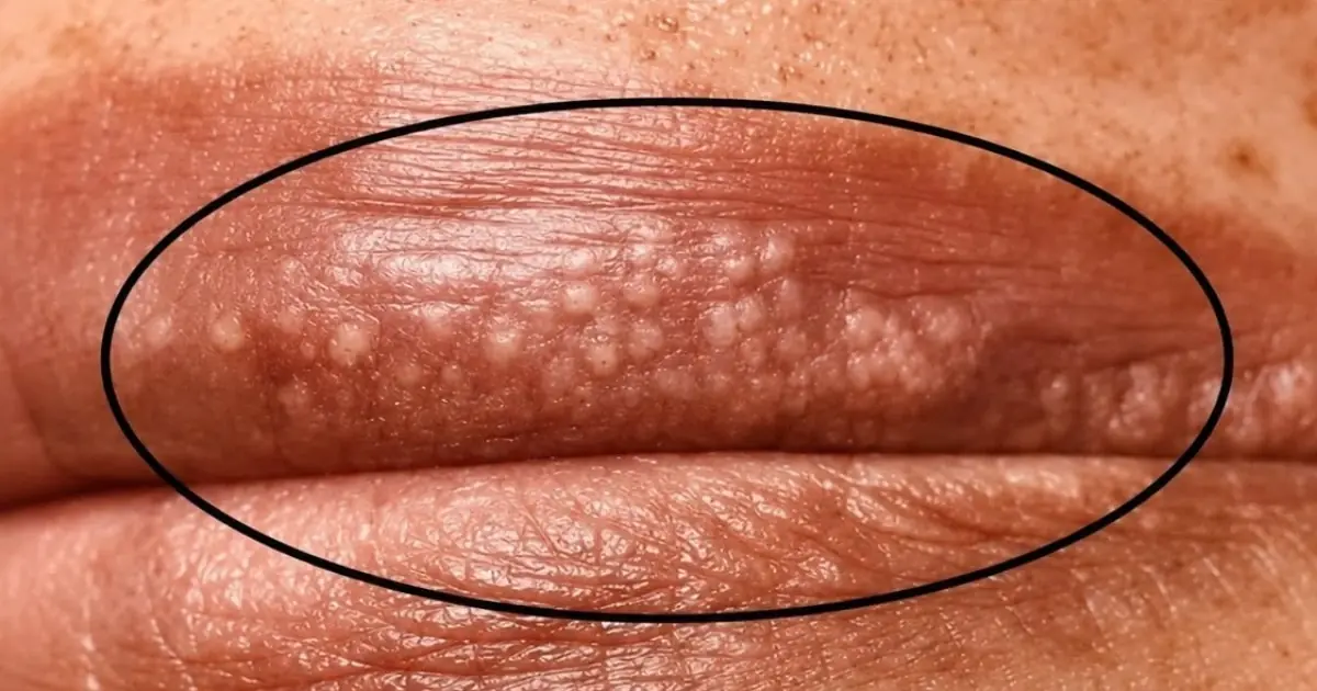 Why Do Small Bumps Appear on the Lips? What Your Skin May Be Telling You