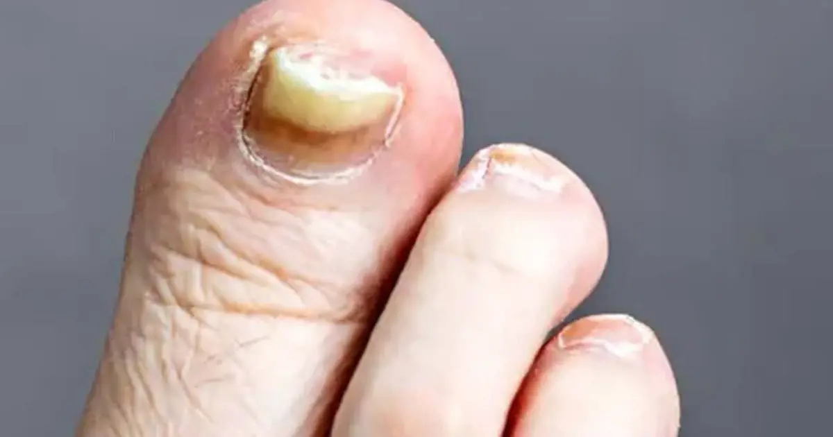 Two Foot Changes That Could Signal an Underlying Health Problem