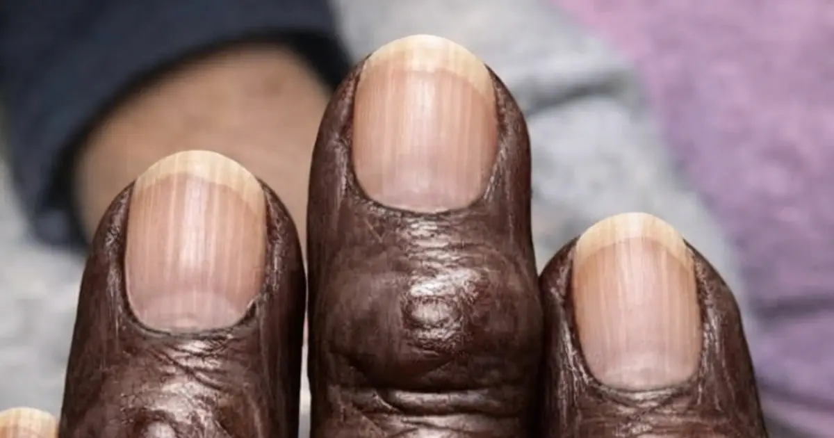 My Grandma Started Getting Hard Bumps Near Her Fingernails — Then They Began Appearing on More Fingers. What’s Going On?