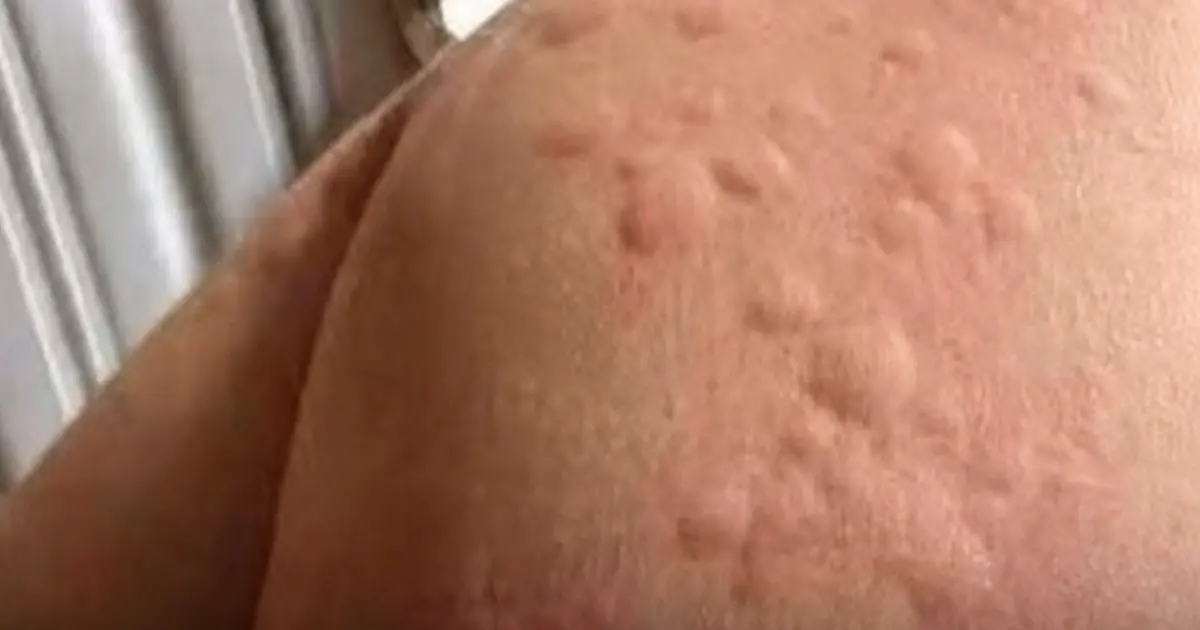 The Silent Skin Condition Affecting Millions — And Why Cases Seem to Be Increasing