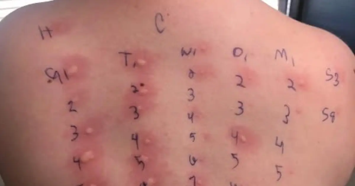 My Poor Baby! Understanding His Allergy Test Results After 15 Minutes