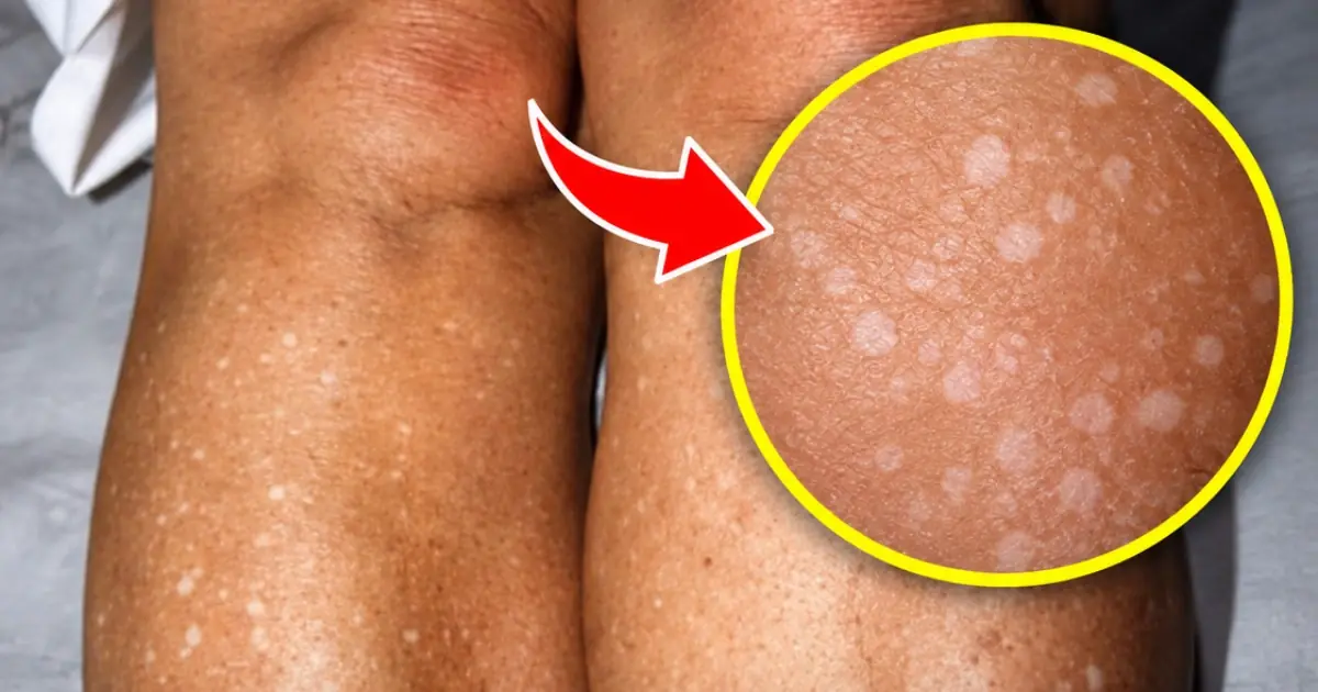 Small White Spots on Your Arms or Legs? Here’s What They Could Mean