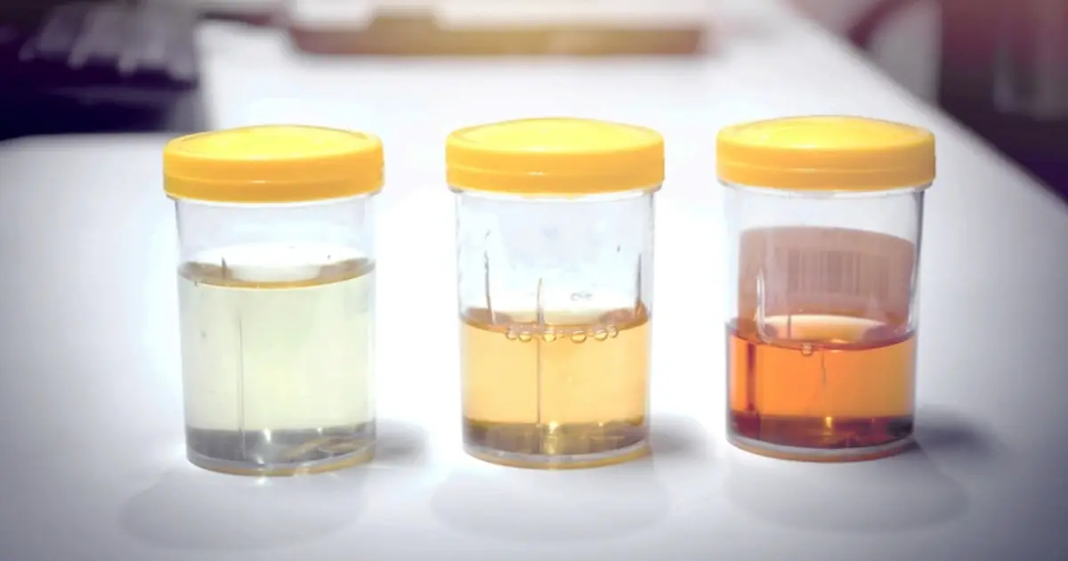 Your Urine May Be Giving You Health Clues - Here’s What Its Color and Odor Could Mean