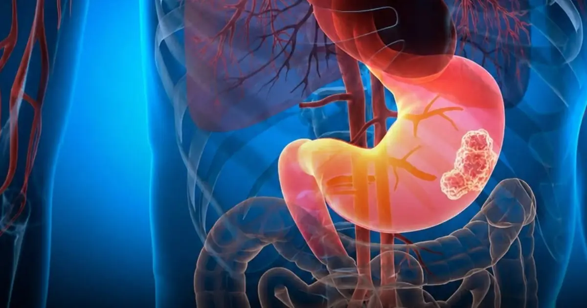 Rising Concerns Over Stomach Health: Breakfast Habits Under Scrutiny