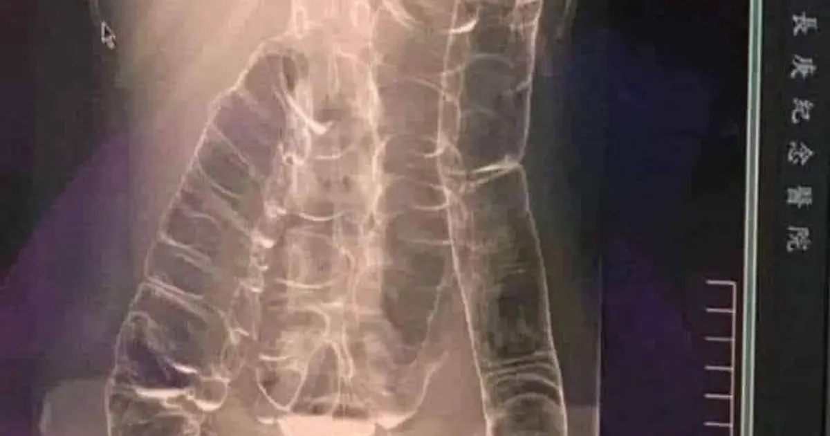 Severe Constipation and Toxic Megacolon: Causes and Solutions