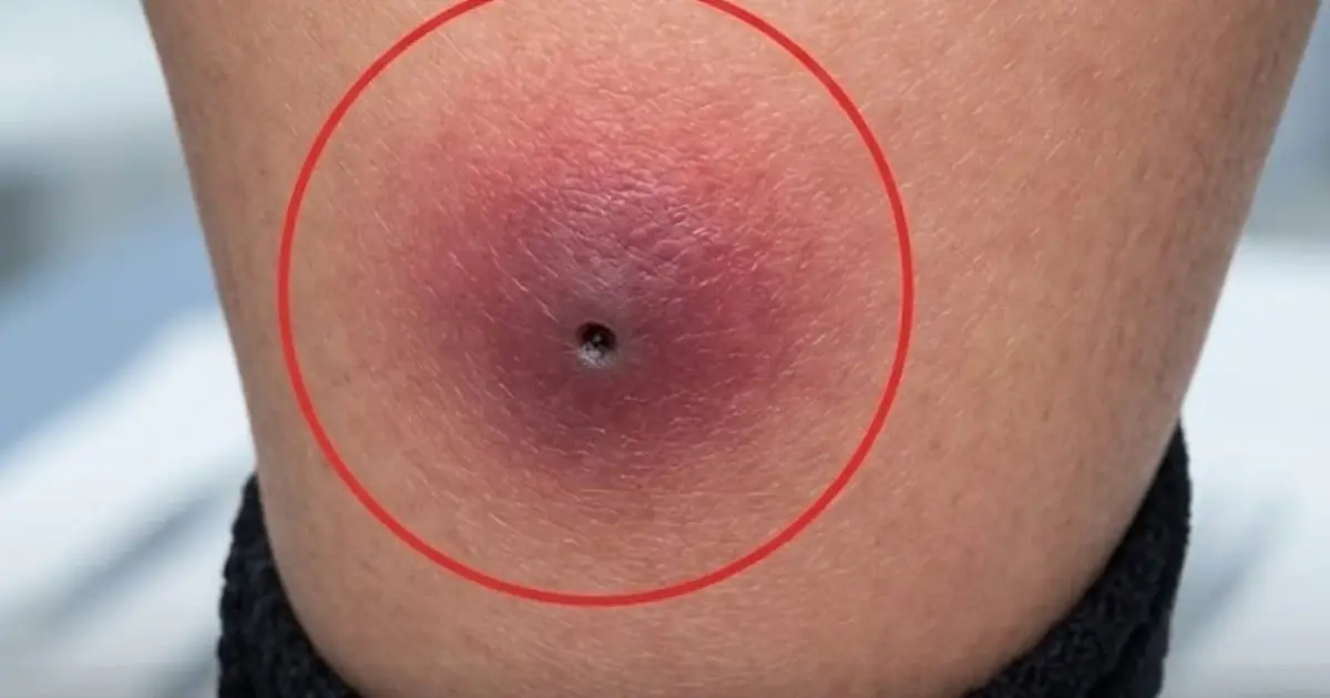 Thought It Was Just the Flu: The Tiny Mark That Changed Everything