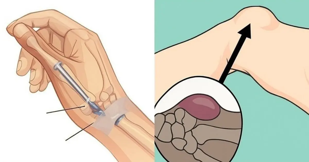 A Small Wrist Bump May Be More Common Than You Think - It Could Be a Ganglion Cyst