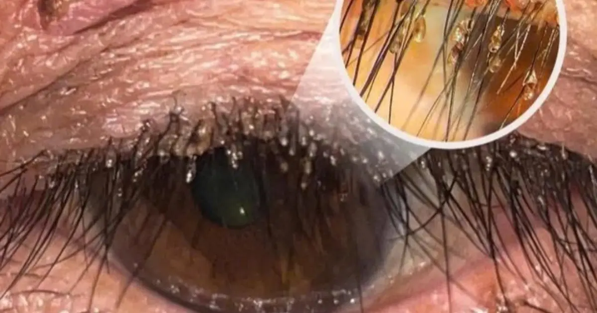 Experts Warn Poor Eye Hygiene During Sleep May Lead to Eye Problems