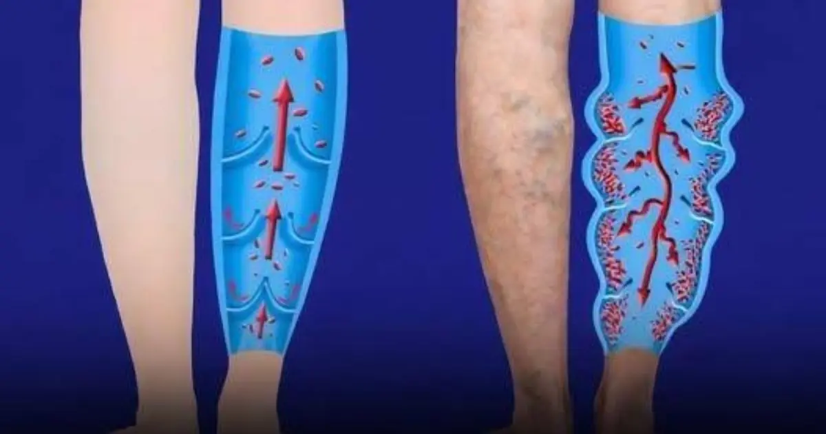 Tired of Poor Circulation and Varicose Veins? Try These 6 Effective Tips