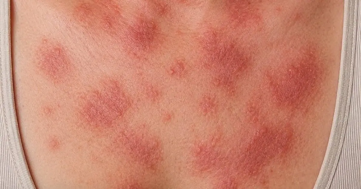 Waking Up With Itchy Red Spots Almost Every Night? Here’s What Could Be Causing Them