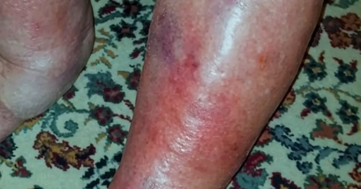 These are the first symptoms of sleeping with... See more