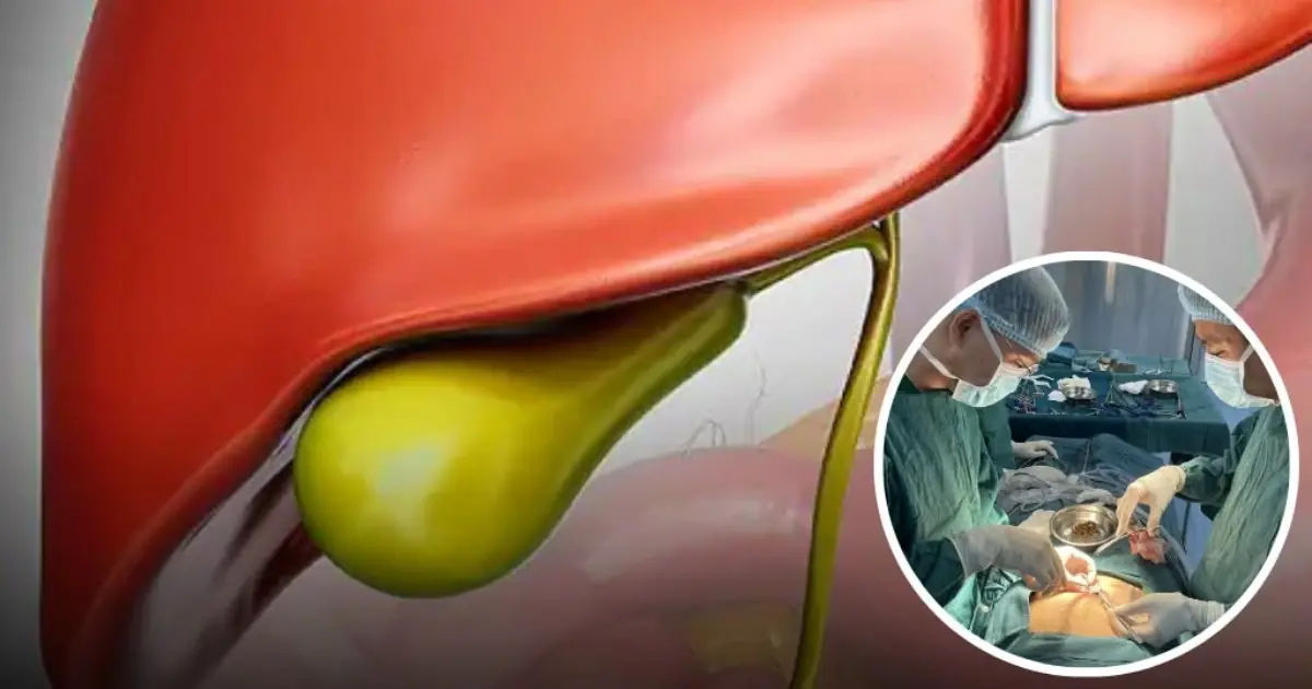 Life After Gallbladder Removal: Understanding the Possible Health Effects