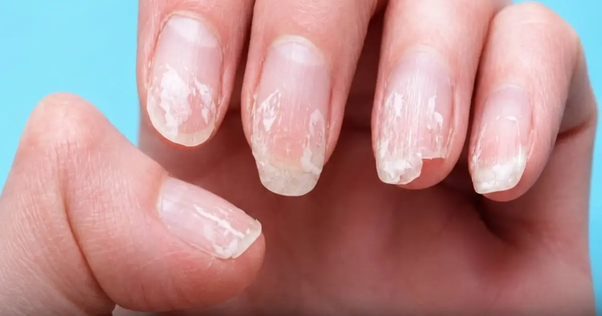 Brittle or Splitting Nails? Your Body May Be Warning You About Nutrient Deficiency
