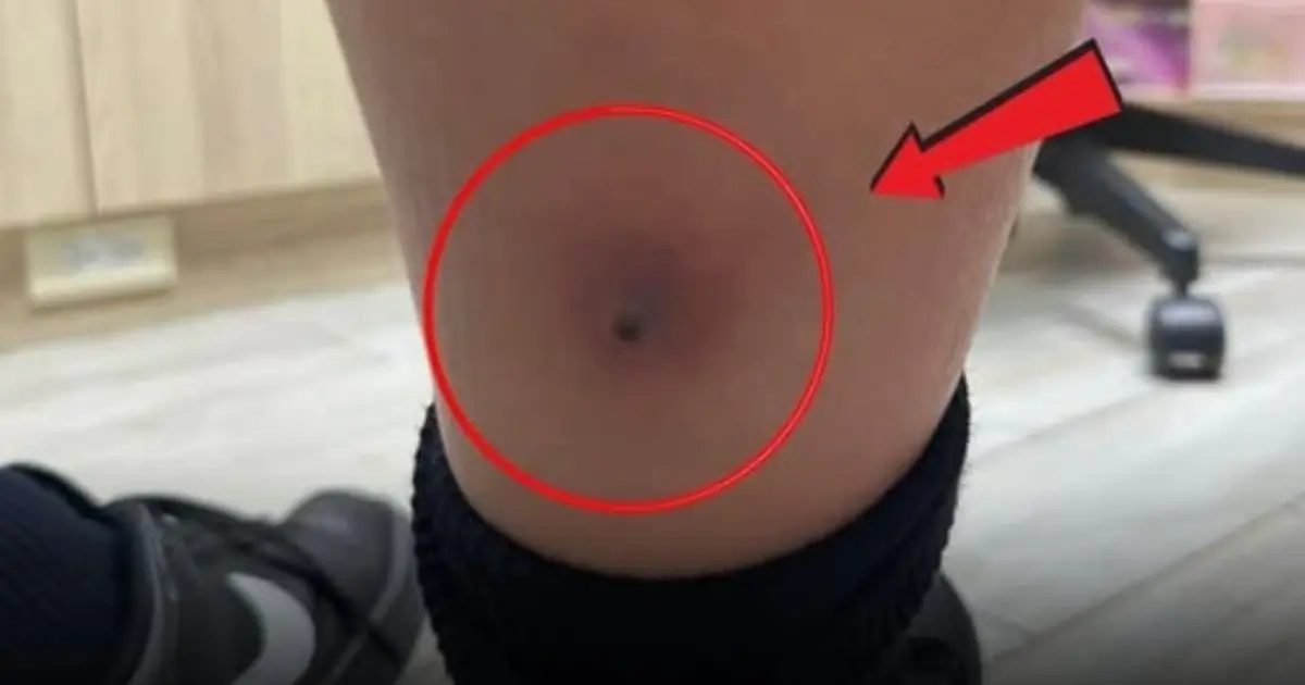 Boy’s Fever Seemed Like the Flu — Until Doctors Discovered a Dangerous Warning Sign
