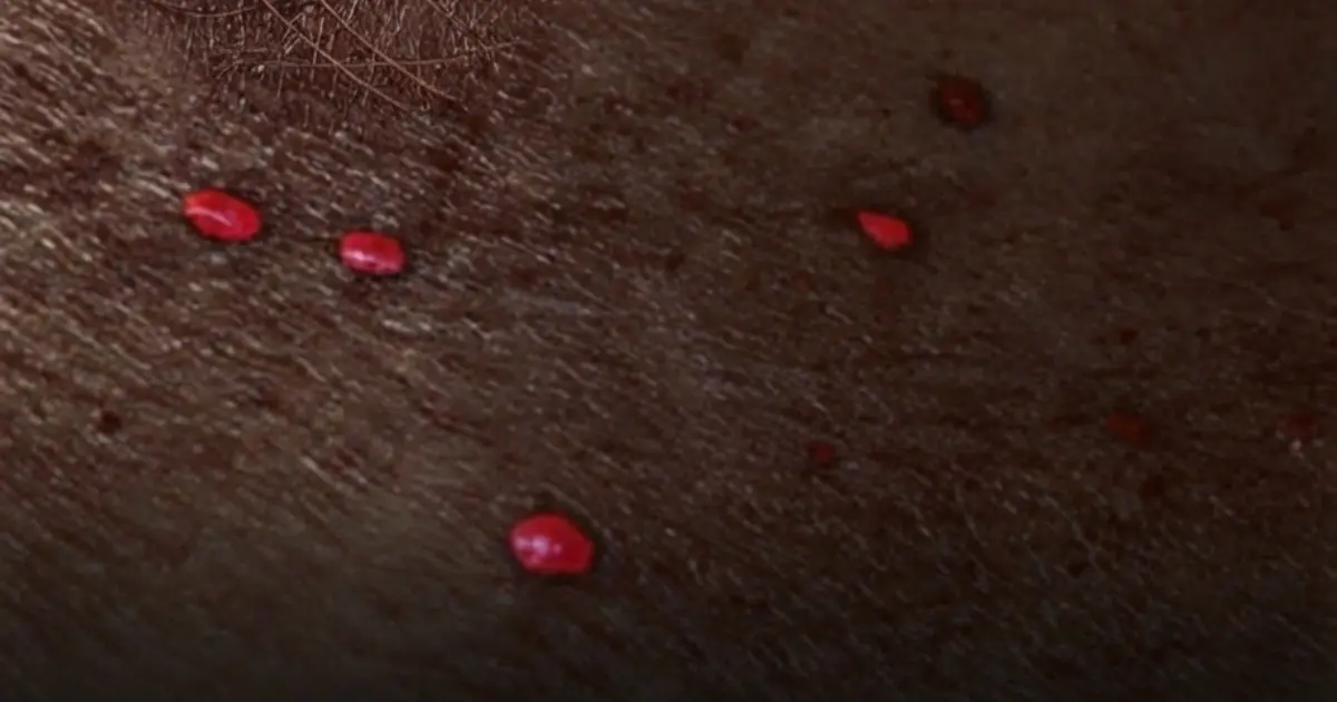 Why Do These Little Red Dots Keep Showing Up on Your Skin? The Answer May Surprise You