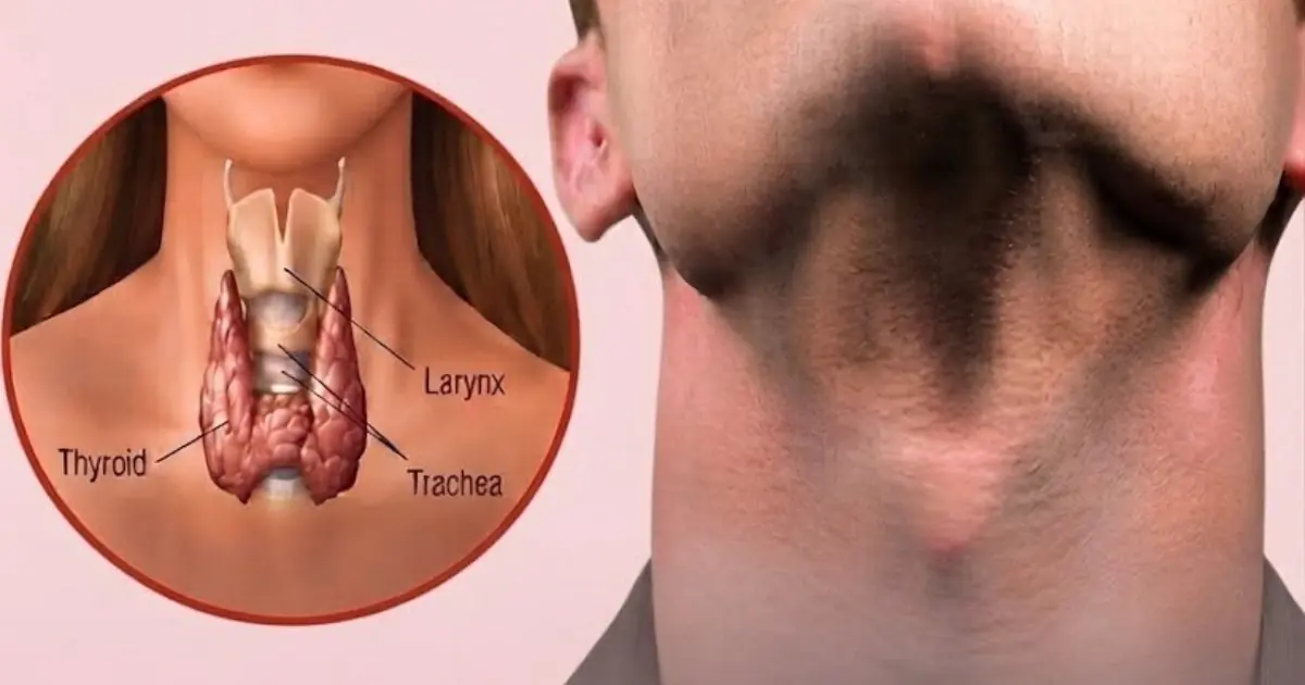 Avoid These 6 Foods That May Affect Thyroid Health: What You Need to Know