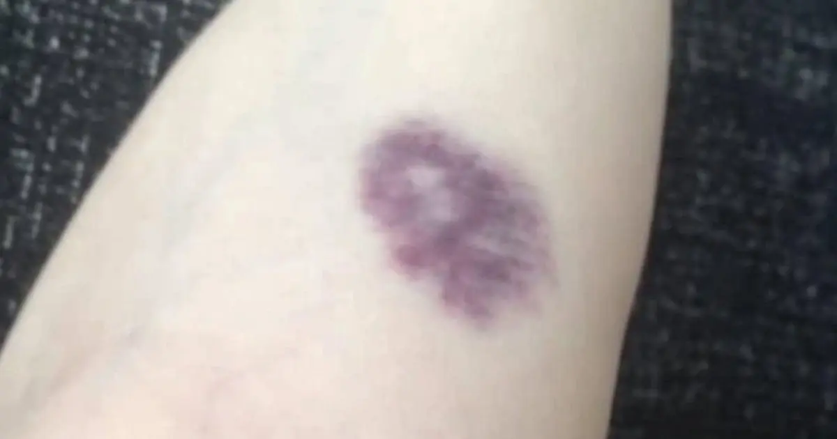 BE CAREFUL, if you get these bruises on your body, it means you have Ca…see more