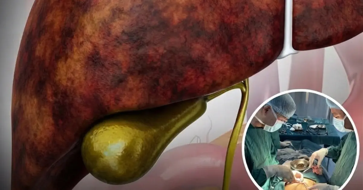 Life After Gallbladder Removal: These Changes May Surprise You — Here’s What to Know…
