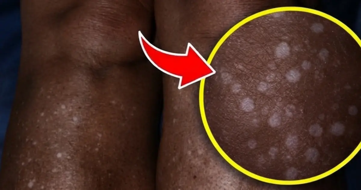 Those Little White Spots on Your Skin May Have a Reason — Here’s What Experts Say
