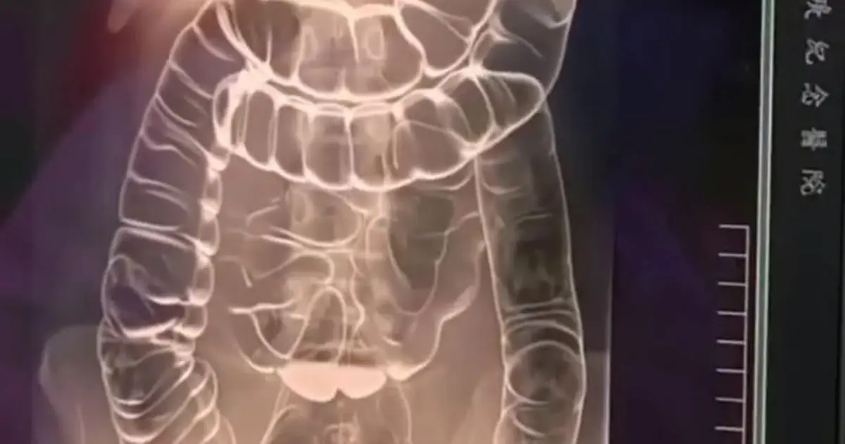 Chronic Constipation: A Hidden Threat to Your Digestive Health
