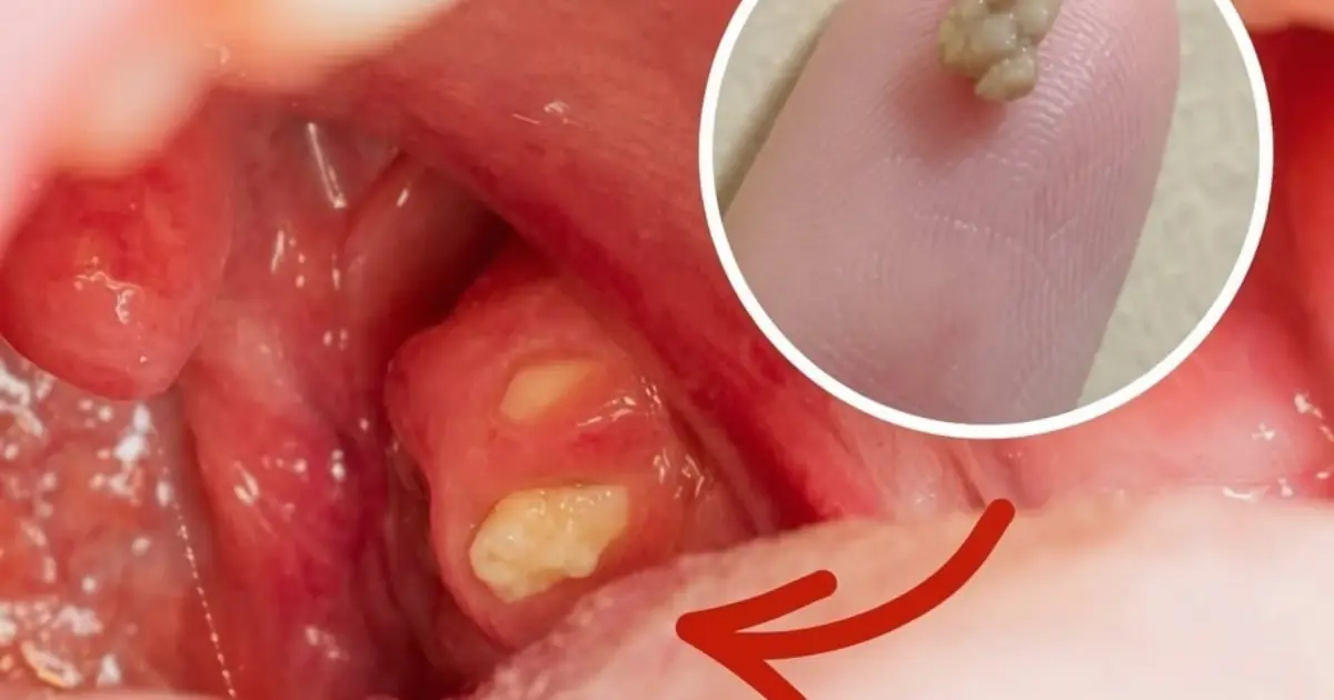 Suddenly Feel Like Something Is Stuck in Your Throat? No Matter How Much You Swallow, It Won't Go Away... T