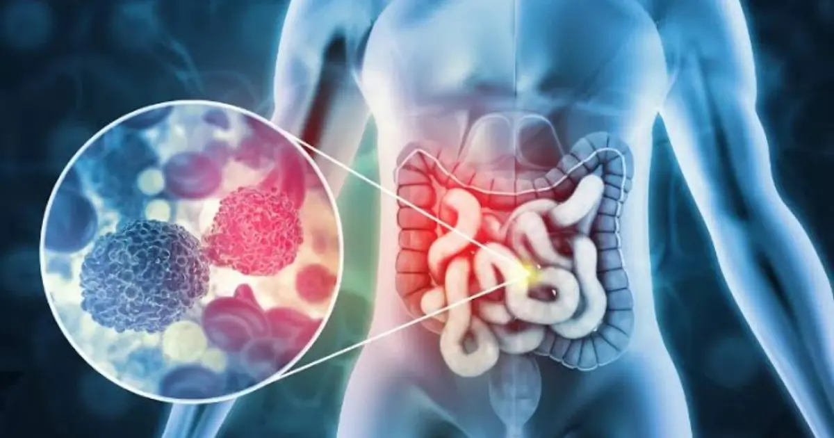 More People Under 50 Are Being Diagnosed With Colon Can.cer - Here’s What You Need to Know