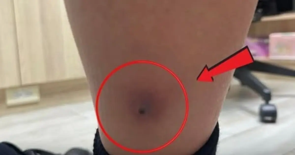 They Thought It Was Just the Flu — Then a Small Spot on His Leg Became a Medical Emergency