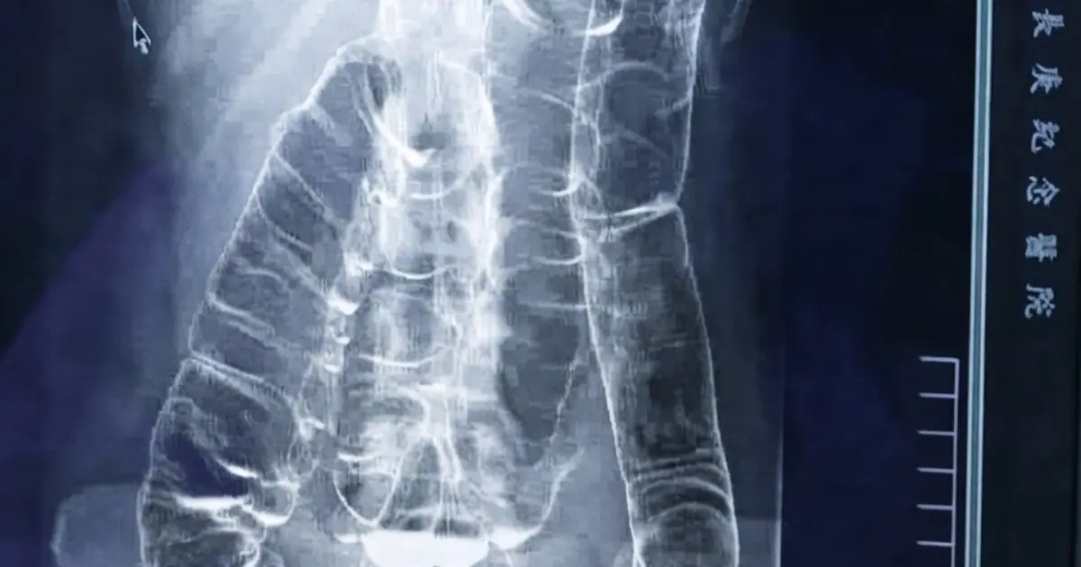 She Kept Telling Herself It Was Only Constipation… Until an X-Ray Revealed Something She Never Expected