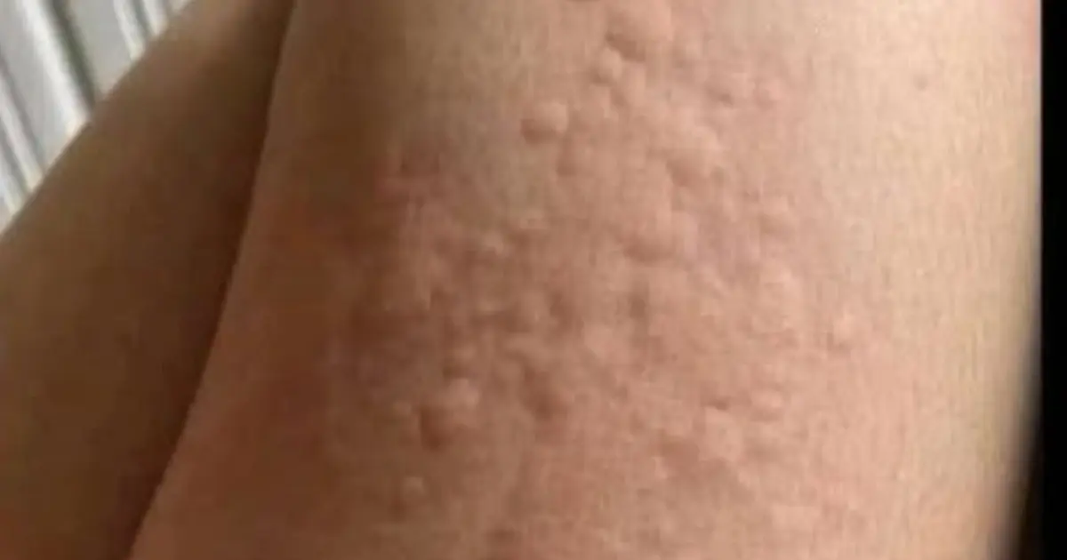 His whole body was itchy, he thought it was an allergy and was diagnosed...See more