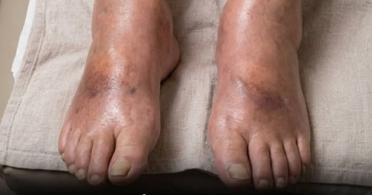 Pancreatic Cancer: 4 Leg Symptoms You Might Be Overlooking
