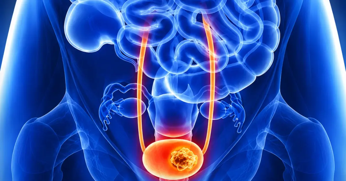 Bladder Can.cer Is a Silent Kil.ler: 10 Signs You Should Never Ignore