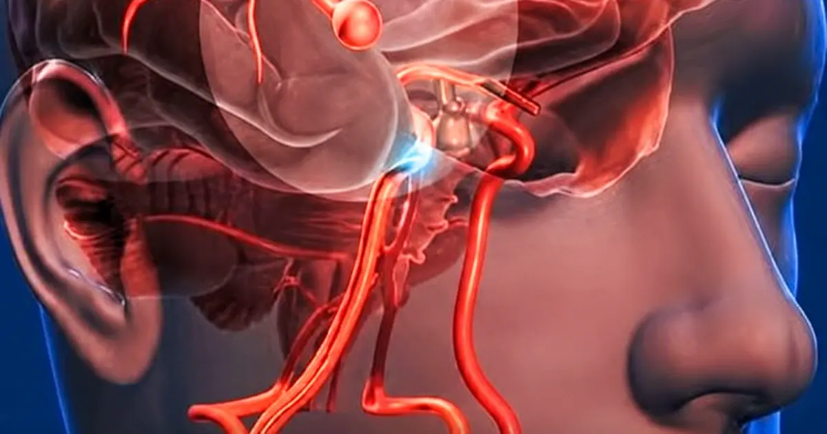 12 Early Warning Signs of an Aneurysm You Shouldn’t Ignore