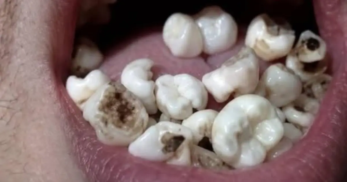 What Does It Mean to Dream About Your Teeth Falling Out