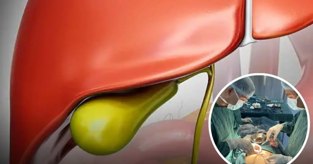 What Happens to the Body After G.allb.la.dder Removal?