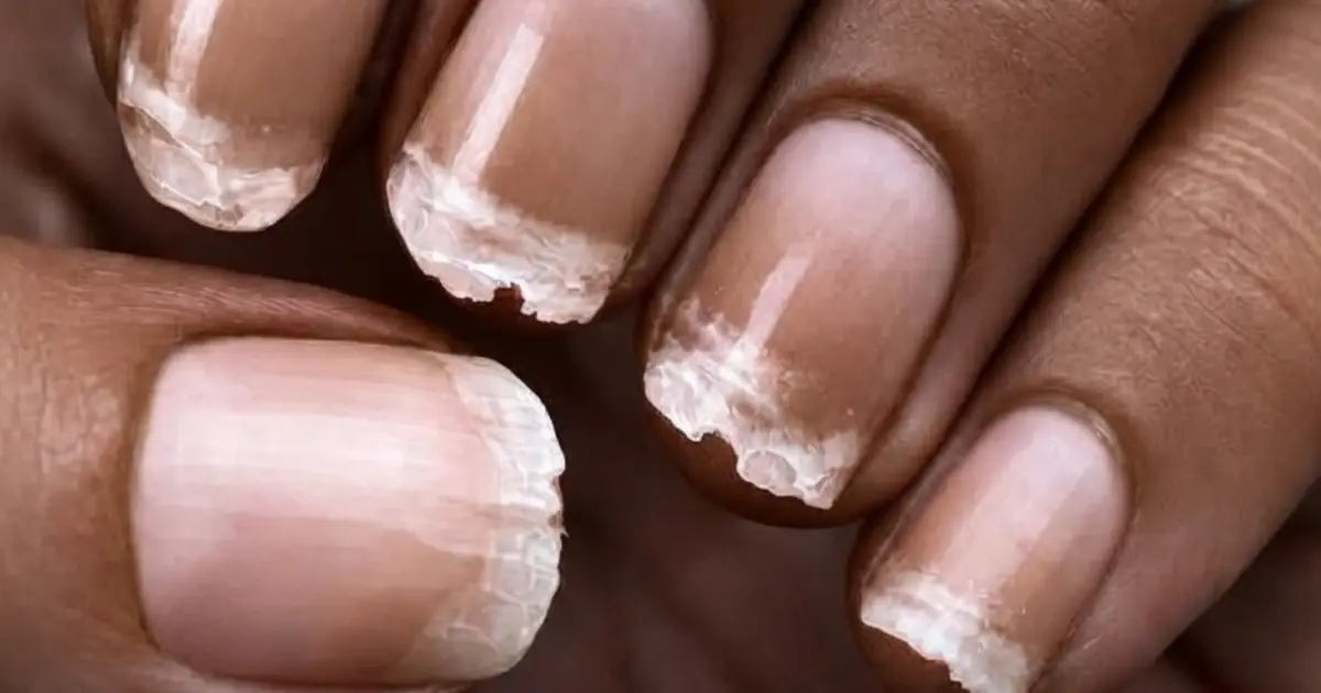 Weak, Brittle Nails? There May Be More Behind Them Than You Think