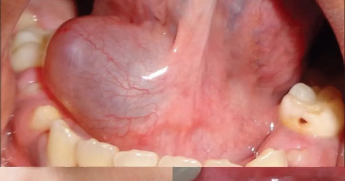 These are the first symptoms of a...