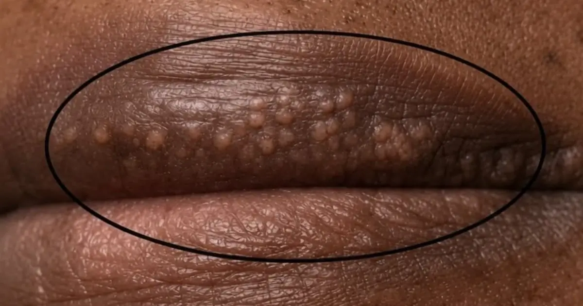 If You Are Getting White Pimples on Your Lips or Intimate Area, Here's What They Could Mean