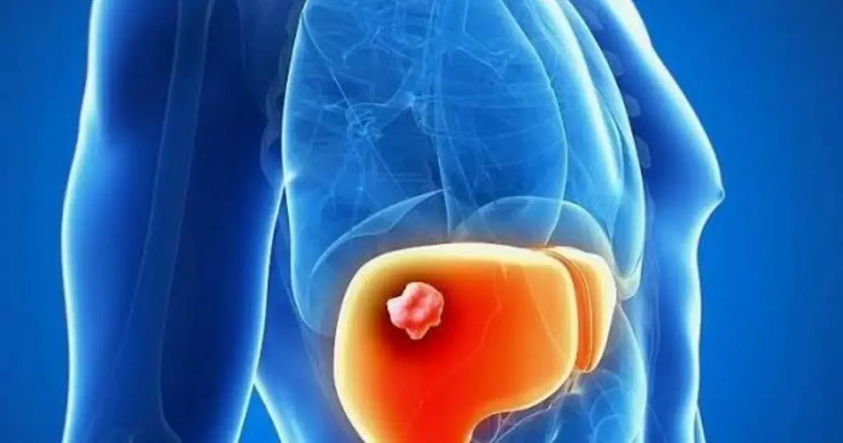Stomach Can.cer Can Be Hard to Detect Early - Here Are the Warning Signs You Should Know