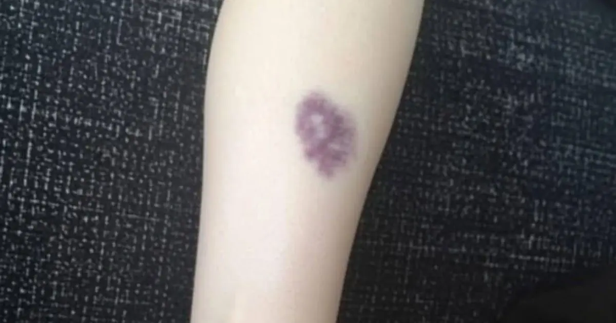 BE CAREFUL: What Unusual Bruises May Be Trying to Tell You
