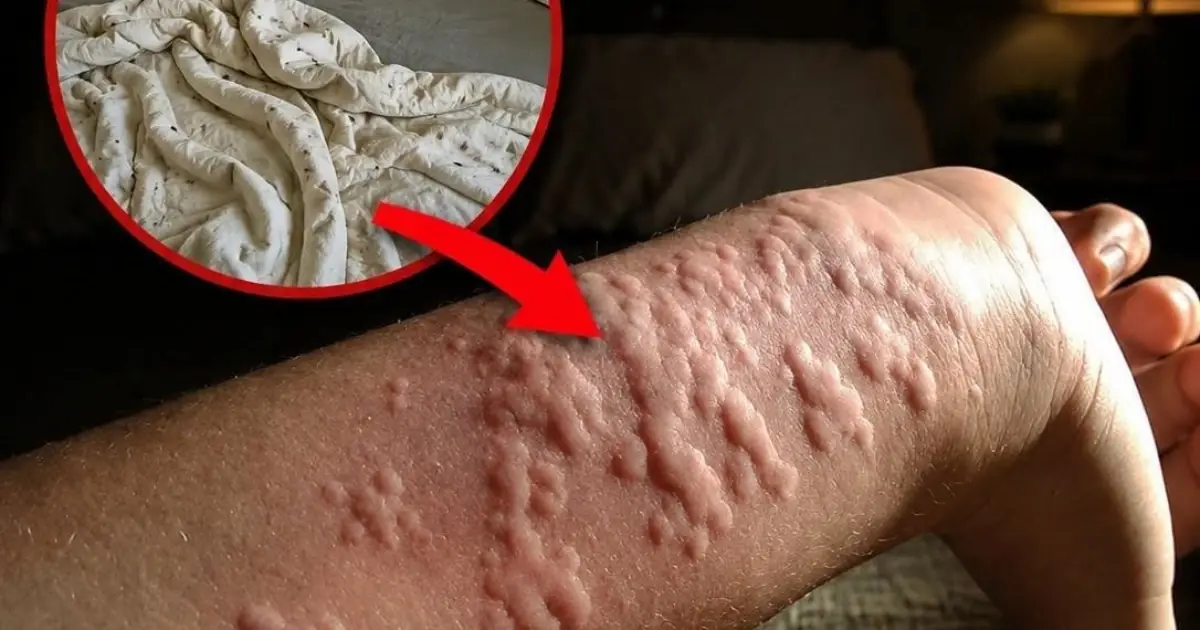 Waking Up With Itchy Bumps? Your Bedding Could Be Hiding an Unwelcome Guest