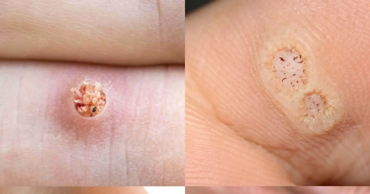 If You Get These Skin Growths, You May Be Infected With HPV: What Warts Can Really Tell You