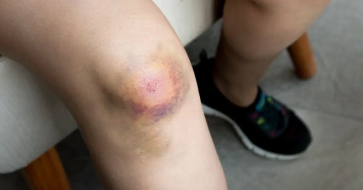 Getting Bruises for No Apparent Reason? Here’s What Your Body May Be Trying to Tell You
