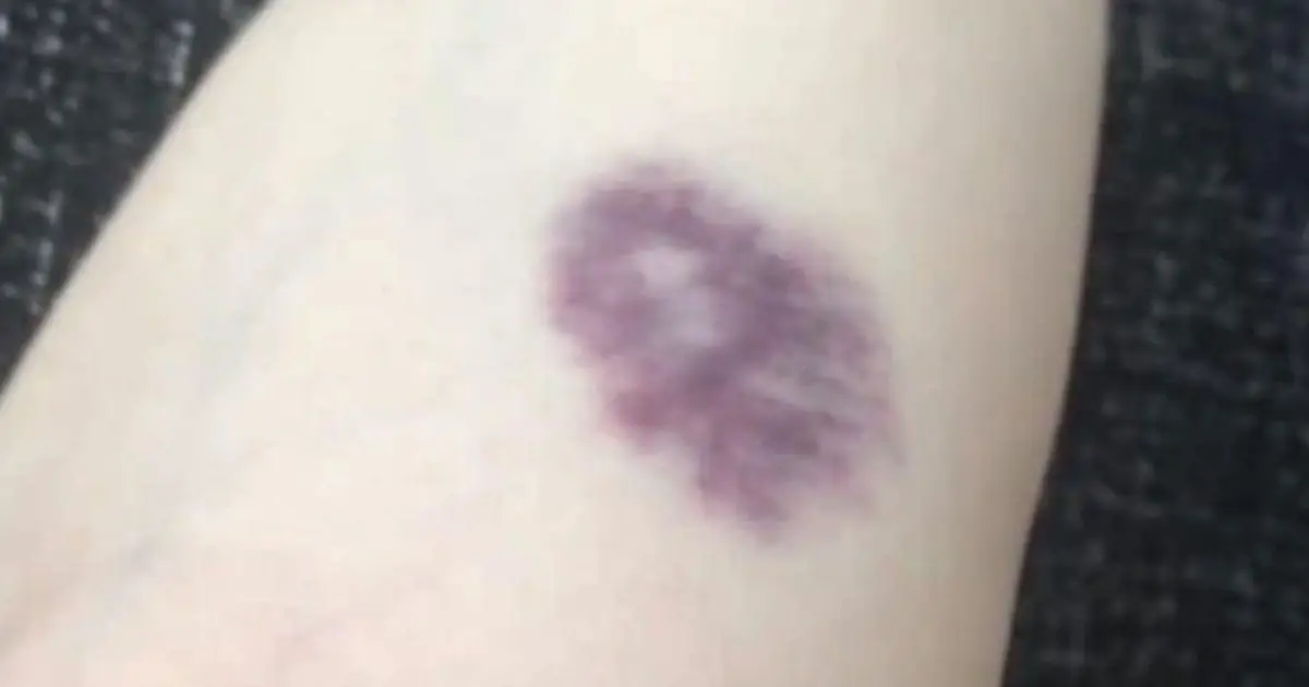 BE CAREFUL: Unexplained Bruises Could Be Your Body’s Warning Sign