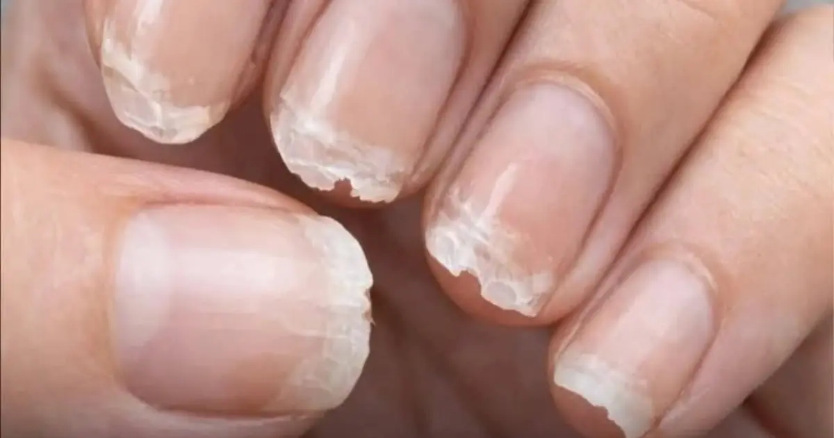 Brittle or fragile nails: what your body is trying to tell you