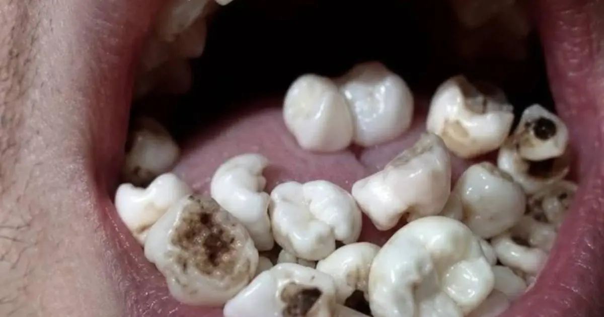 What Does It Mean to Dream About Your Teeth Falling Out Find Out