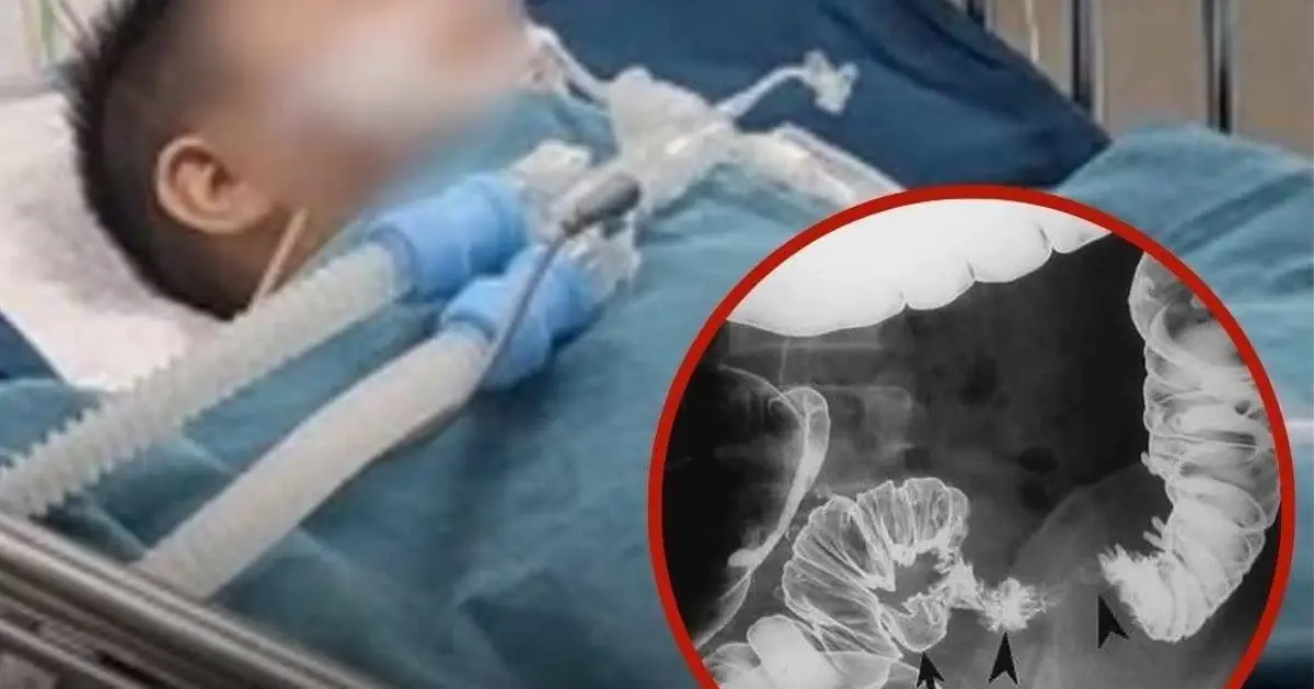 Second-Grader Diagnosed with Colon C.anc.er After Regularly Eating These 2 Foods Since Childhood