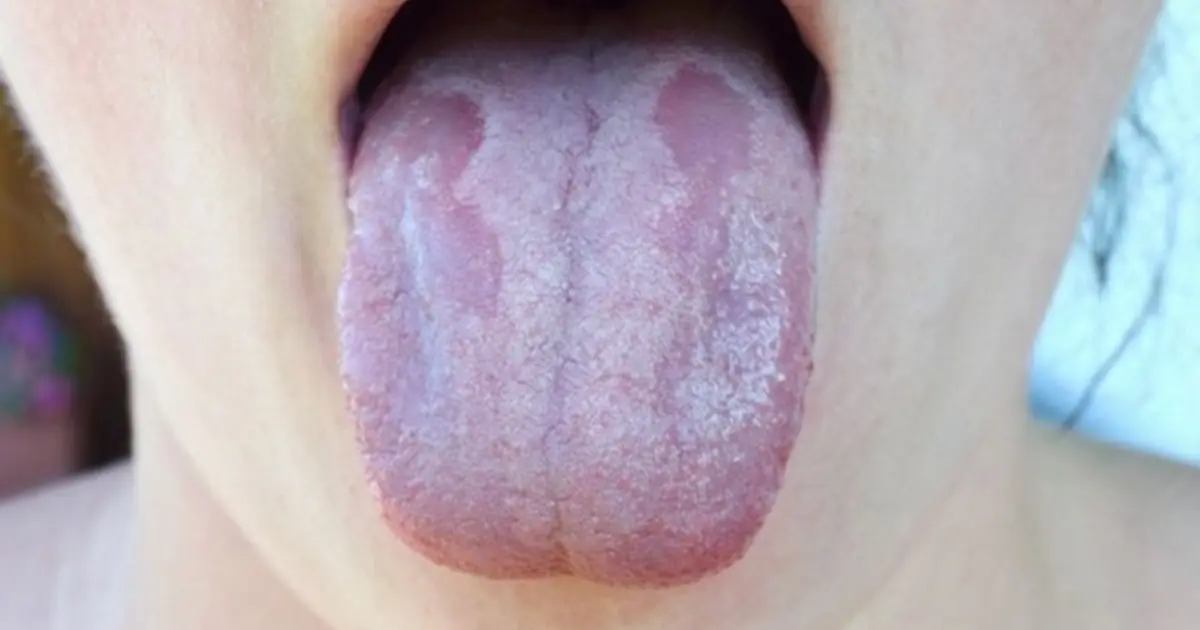 A White Tongue May Reveal More About Your Health Than You Think