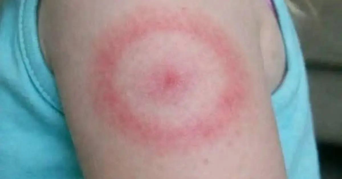 My daughter woke up with this strange red ring on her arm.
