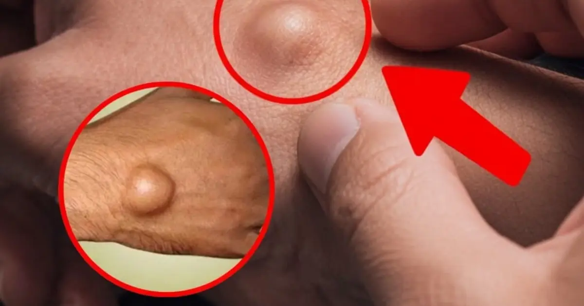 A New Lump on Your Hand? Learn What It Could Mean Before Ignoring It